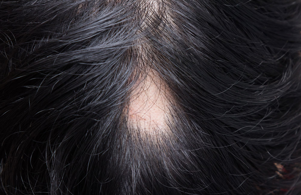 Nikita Hair Flekkvis hårtap Alopecia Areata